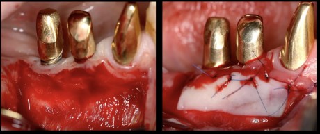 Surgical interventions to gain keratinized mucosa also applying soft tissue substitutes